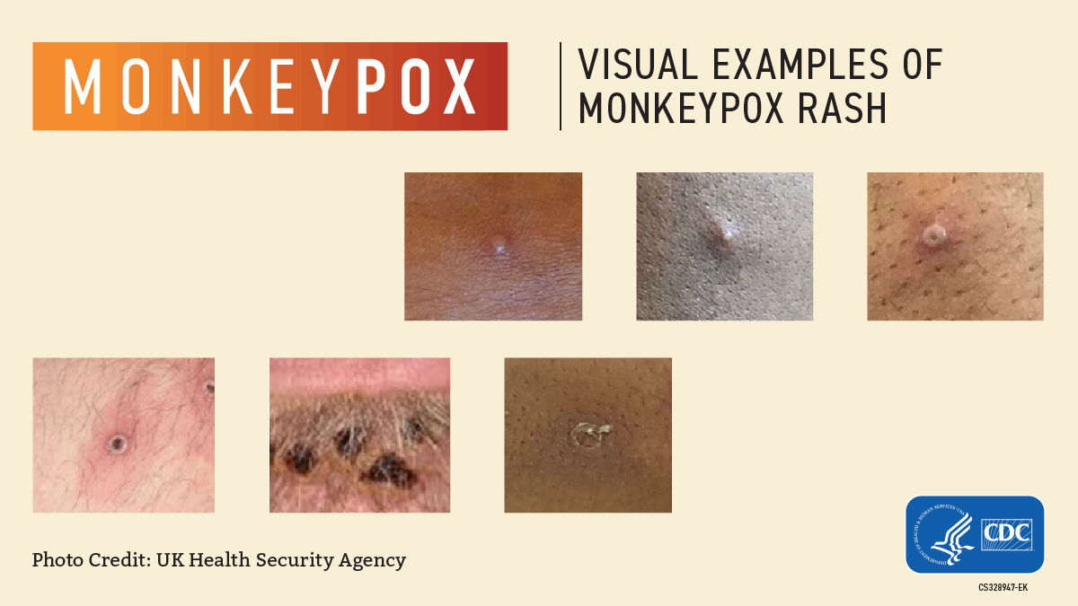 CDC Monkeypox Rash Images Social Media Graphic-English